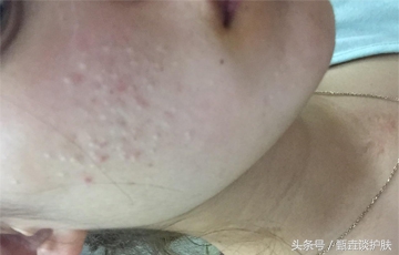 战痘神器推荐,战痘神器