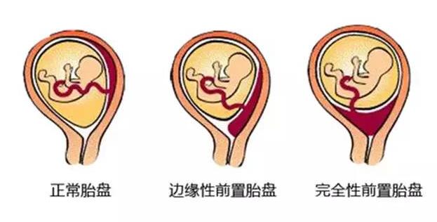 宫外孕大出血需要怎么处理,宫外孕为什么会引起大出血