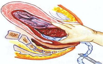 刻骨铭心的经历永生难忘,手动剥胎盘的经历