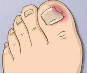 脚趾甲里又长了一层脚趾甲怎么办,脚趾甲往肉里长有啥好办法