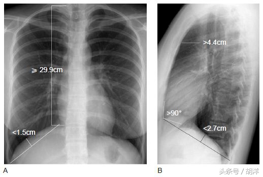 为什么有的人抽烟不会有肺气肿呢,有的人抽烟喝酒为什么长寿