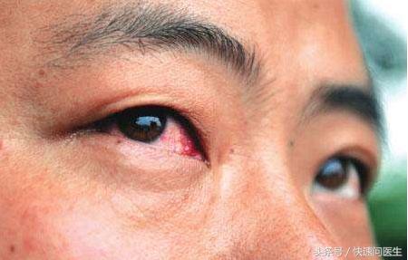 白眼球发黄怎么回事结膜炎,结膜炎白眼球为什么越来越红