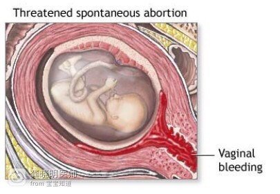 医学科普怀孕50天见红,妇产科医生科普孕期出血