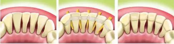 牙周病的五种治疗方法,牙周病的最佳治疗方法