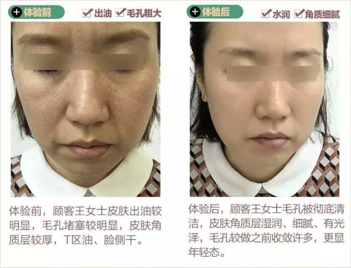 五合一超微小气泡嫩肤仪,天津美莱吸脂怎么样