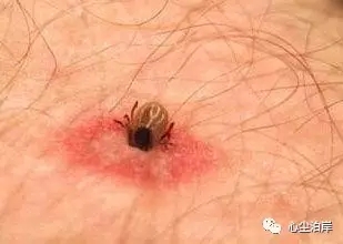 假如被毒蛇咬了会怎么样,假如被毒蛇咬应该怎么办