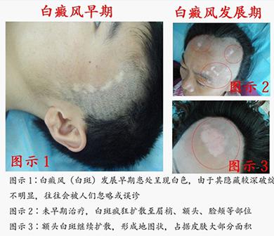 治好白癜风要花多少钱,白癜风治疗要花多少钱合适