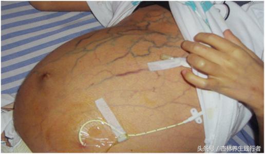 乙肝怎样预防肝癌发生,乙肝怎么预防肝癌的发生