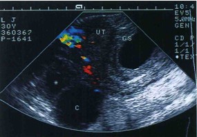 卵巢囊肿的b超描述,卵巢生理性囊肿的b超影像
