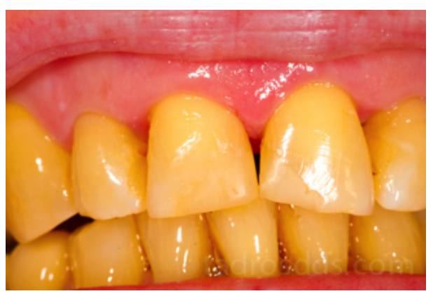 牙越来越黑是什么原因,牙为什么会黄或黑