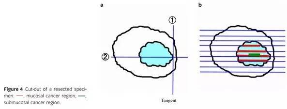 日本消化器内视镜学会结直肠ESD/EMR指南2015版（下）