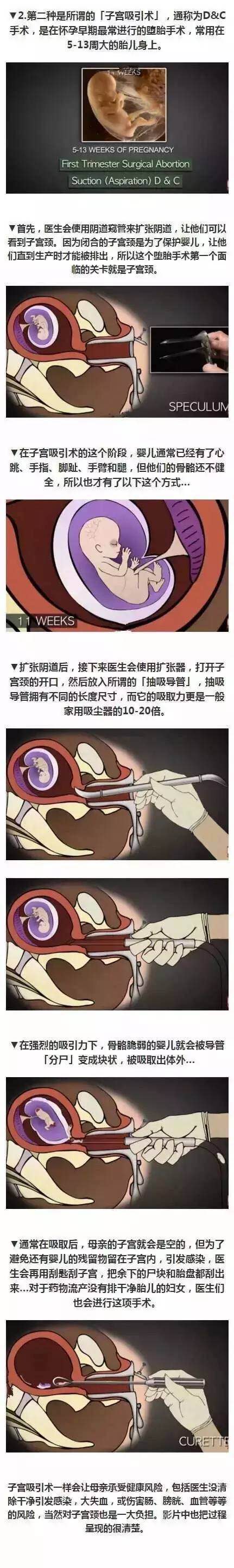 无痛人流可怕还是剖腹产可怕,人流后来姨妈量多的可怕