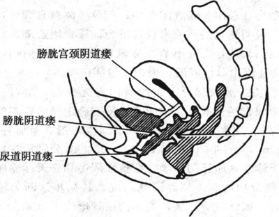 尿瘘护理讲课视频,尿瘘手术知识宣教