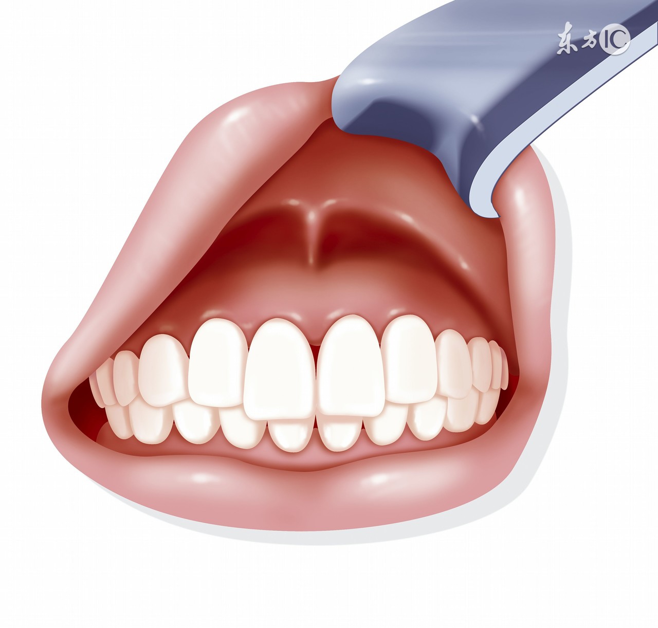 牙龈不增生的降压药,降压药引起的牙龈增生会好吗