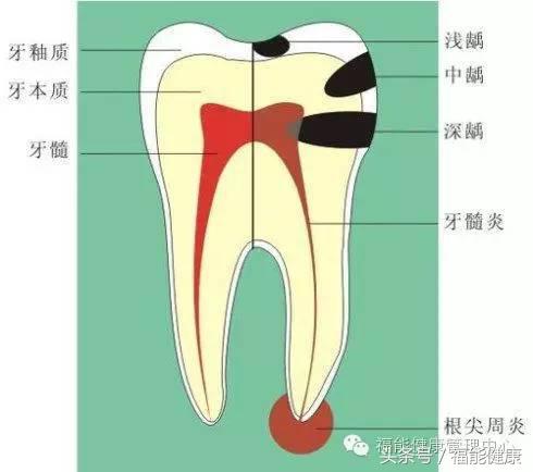 不爱吃甜食为什么会有虫牙,不爱吃甜的为何会糖尿病