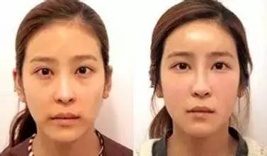 瘦脸针都拯救不了的大饼脸,瘦脸针不能一劳永逸吗