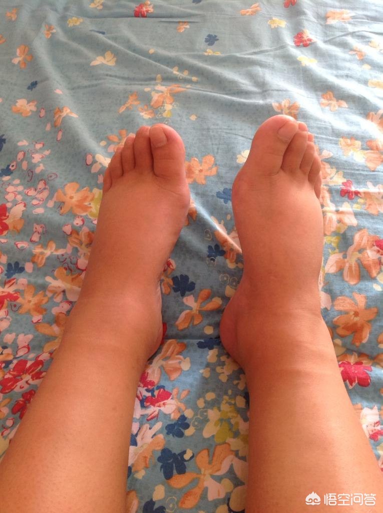 骨折手术后有点隐隐的疼正常吗,骨折手术后下肢血栓怎么办