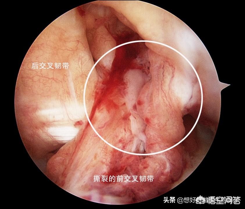 交叉韧带撕裂什么症状,交叉韧带撕裂怎么恢复正常