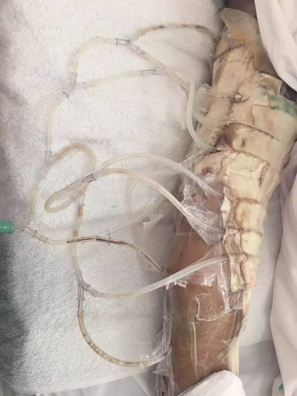 感冒脓毒血症,小孩感冒引起的脓毒血症