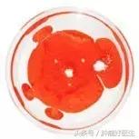 原位癌与转移癌的区别,病理如何判断原位癌和浸润性癌