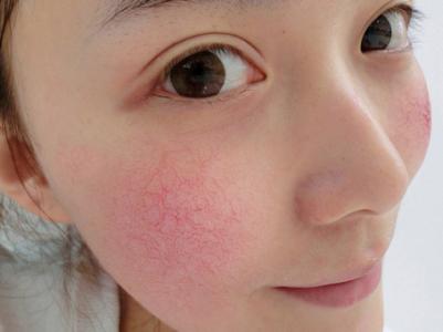 面膜涂抹式改善红血丝,面膜红血丝修护