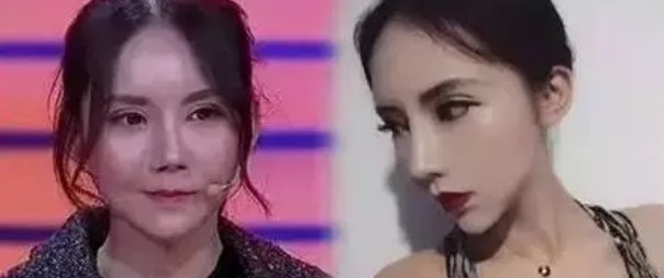 做双眼皮一个星期后感觉太宽了,第一次做双眼皮太窄了