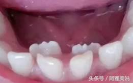换牙期间怎么做才能让牙齿长整齐,小孩牙齿长得太疏换牙会丑吗