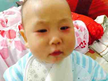 孩子上火该注意什么,春季儿童上火注意事项