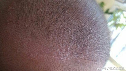 怎么预防宝宝奶癣复发,婴儿奶癣有什么办法解决