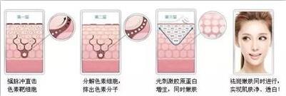 雀斑真的能激光祛除吗,光子祛斑和激光祛斑