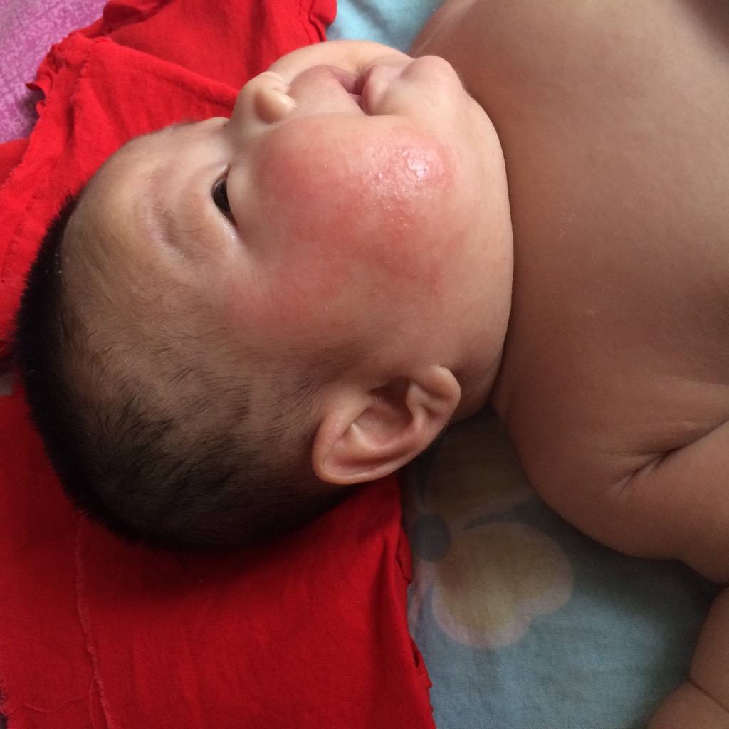 如何快速祛痱子湿疹,湿疹热疹痱子的区别