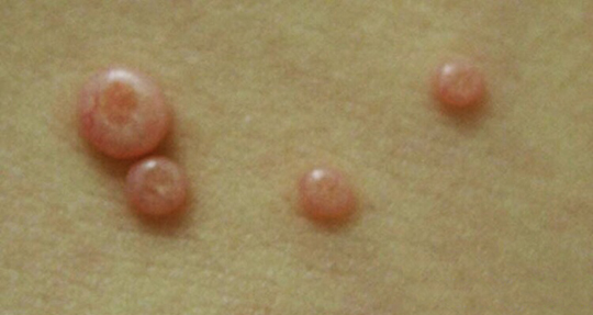 身上长小肉疙瘩有啥危害,身上长了小肉疙瘩能治愈吗