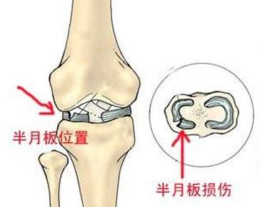 膝关节疼痛伸缩有响声怎样治疗,膝关节活动有轻微弹响