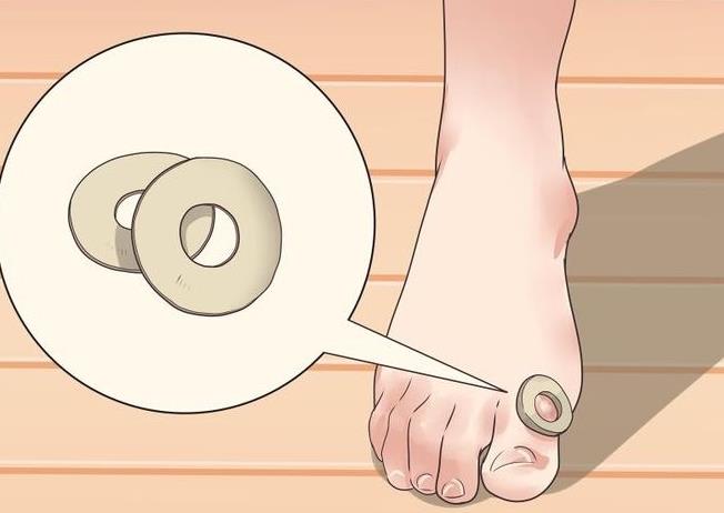 医院治不好鸡眼,发现鸡眼怎么治