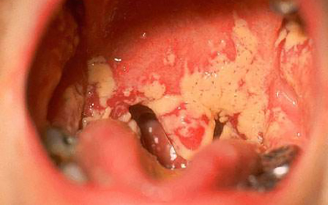 戒烟后的咳嗽症状什么时候能消失,30多年的烟龄戒烟后有什么症状