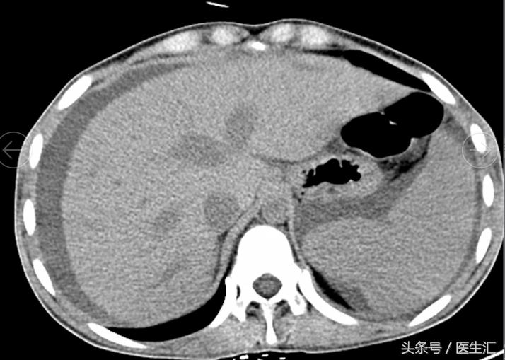 感染会导致腹水吗,腹水感染科