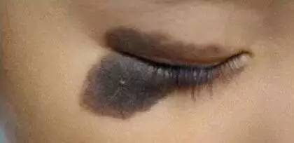 初生婴儿痣和胎记怎么区别,孩子长痣和胎记区别