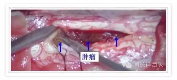 闫长祥脑膜瘤,闫长祥能治愈弥漫中线胶质瘤吗