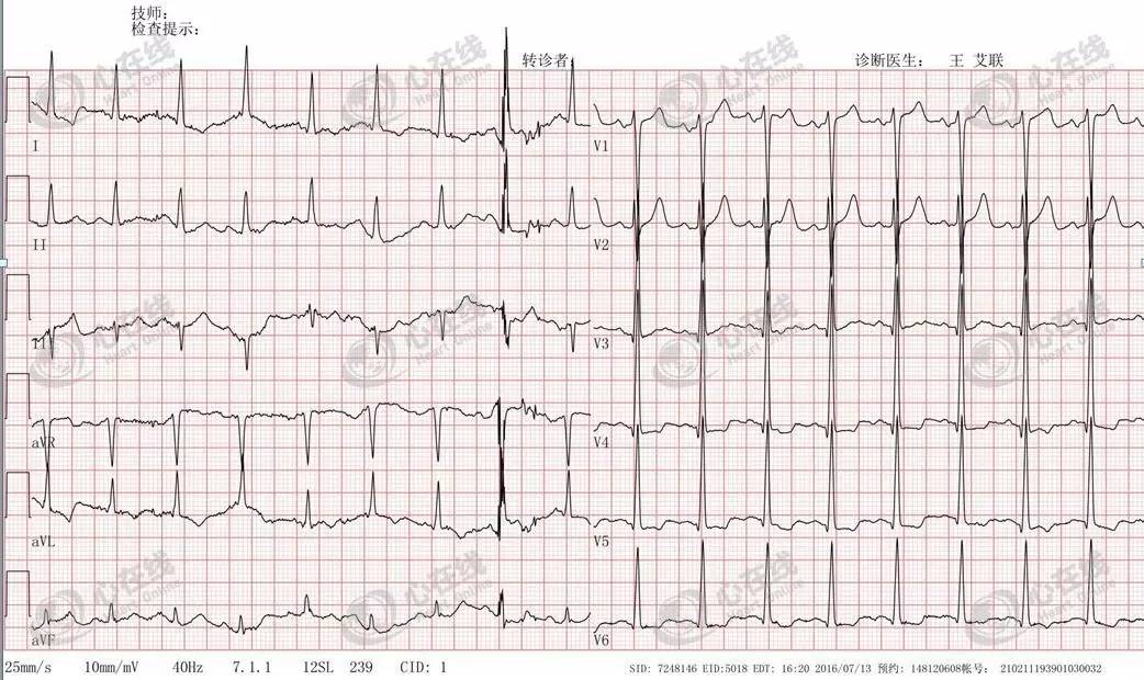 急性心肌梗死心源性休克时的处理,急性心肌梗死心源性休克最常见