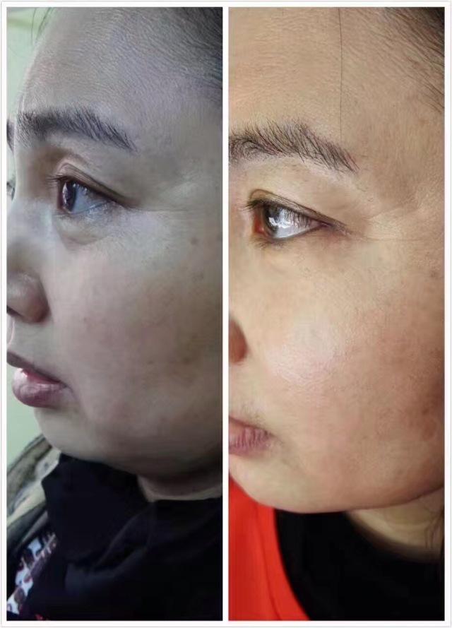 熊猫眼怎么祛除鱼尾纹,熊猫眼怎么去鱼尾纹