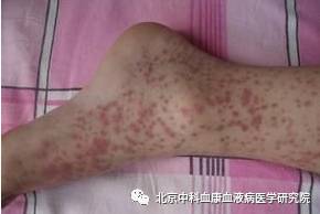 过敏性紫癜案例分享,过敏性紫癜的基本常识