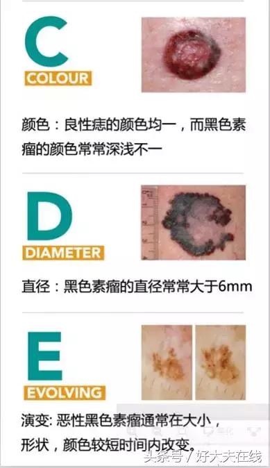 出生就有的黑痣是黑色素瘤吗,长多大的黑痣有可能是黑色素瘤
