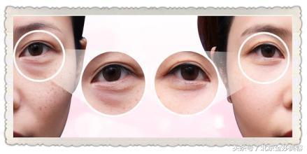 长期黑眼圈该如何调理,长期的黑眼圈有什么方法可以消除