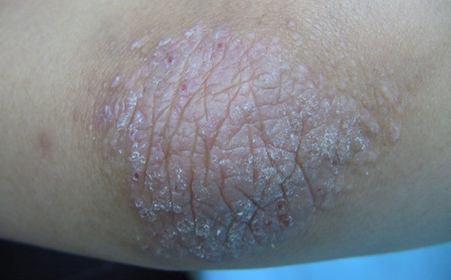 神经性皮炎治好后皮肤能恢复吗,神经性皮炎用冷冻疗法是否能治好