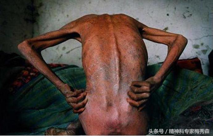 毒品戒断症状最严重的时间,吸烟者戒断反应的表现症状