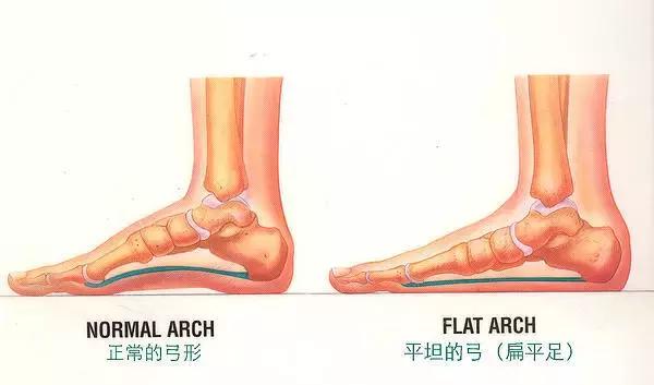 长时间走路脚跟痛怎么解决,足弓和脚后跟痛怎么回事