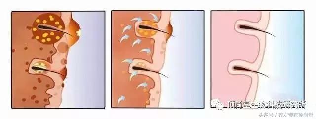 怎样降低雄性激素减少脱发,男性雄性激素脱发的治疗方法