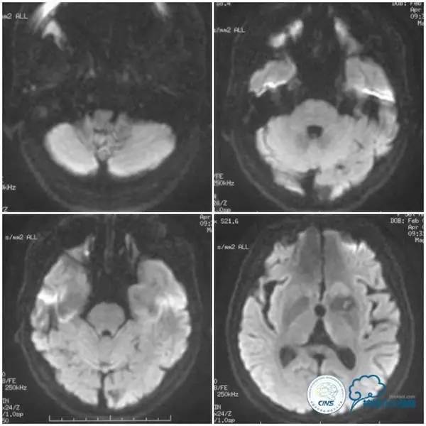 天坛周记,天坛医院脑动脉狭窄
