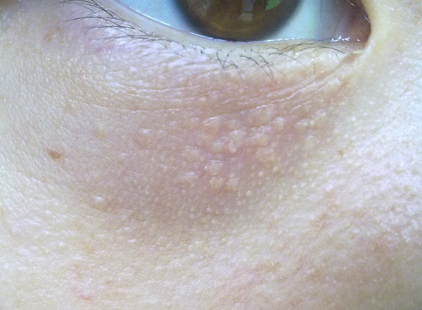 脖子上的脂肪粒消除最快方法,脸上脂肪粒消除最快方法