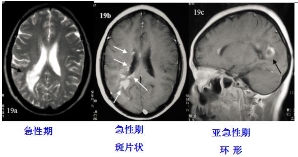医学干货：瘤样炎性脱髓鞘病与胶质瘤、PCNSL临床、影像鉴别